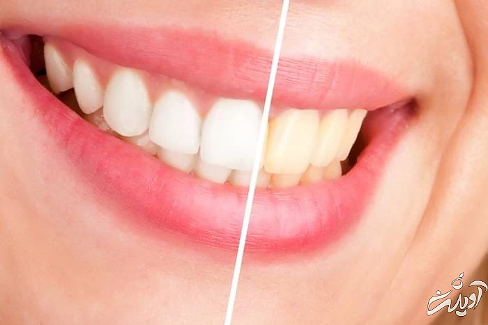 آسیب مینای دندان